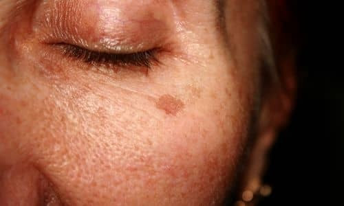 Comment se débarrasser de l'hyperpigmentation ?