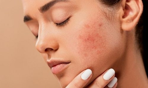 Quelles solutions pour apaiser une peau irritée ?